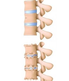 Healthy spine and spine affected by osteochondrosis