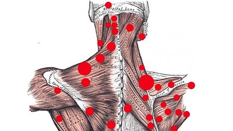 Trigger points in the muscles that trigger myofascial back pain
