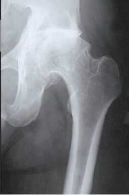 MRI scan of the affected hip joint