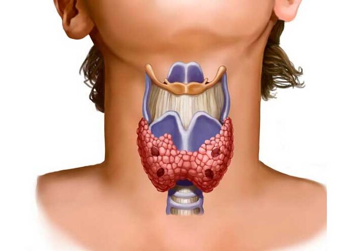 Thyroid problems cause neck pain