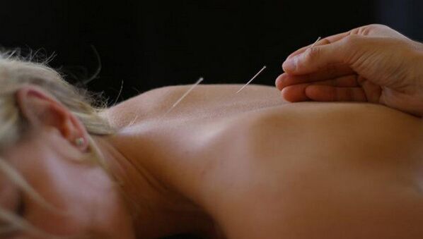 Acupuncture for back pain