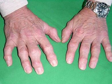 Finger joint disease