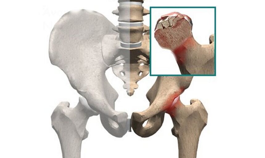 Femoral head necrosis is a cause of hip pain