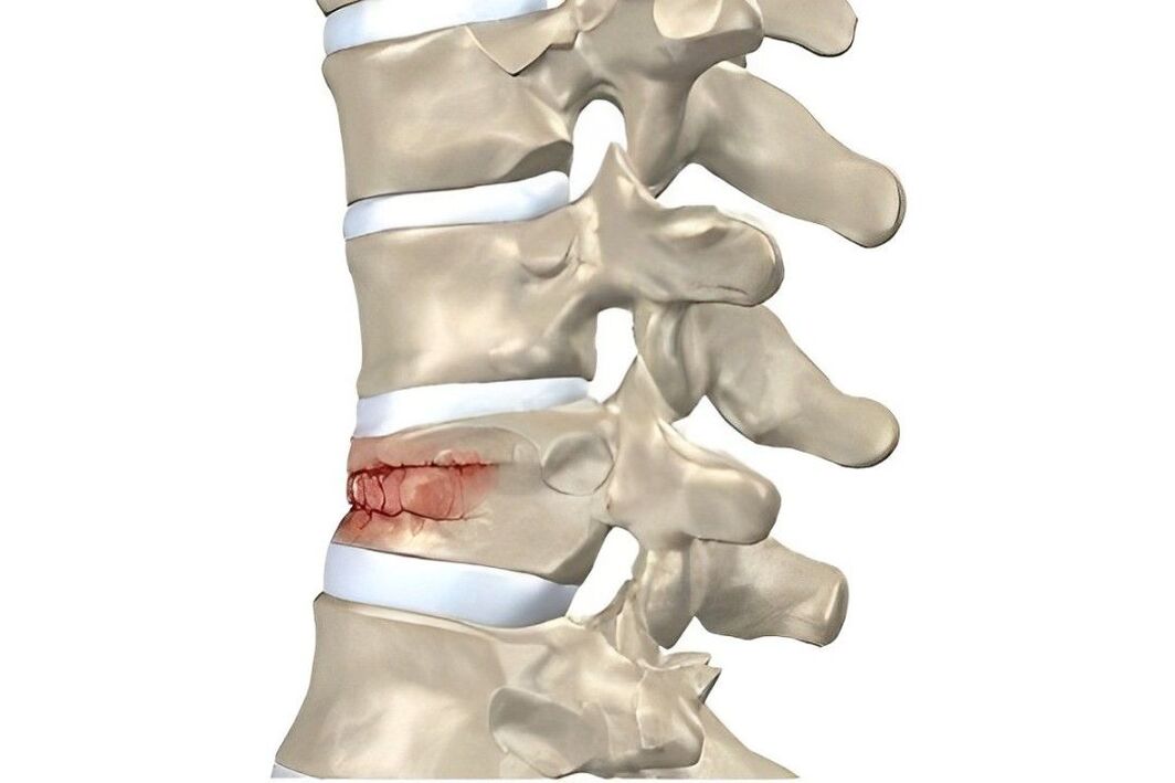 Degree of spinal injury