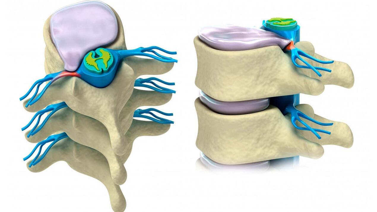 damaged intervertebral discs