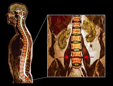 Degenerative disks in the spine