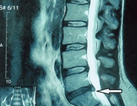 MRI scan shows herniated disc