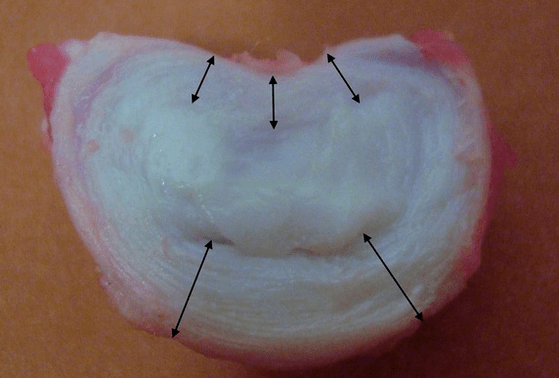 What does an intervertebral disc look like