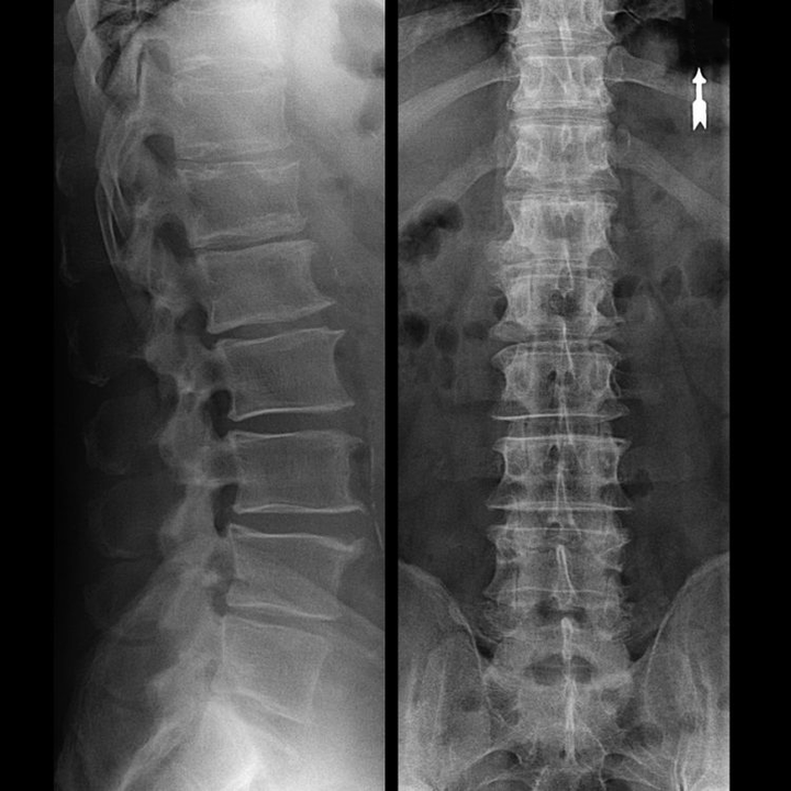 X-ray shows osteochondrosis in vertebral area