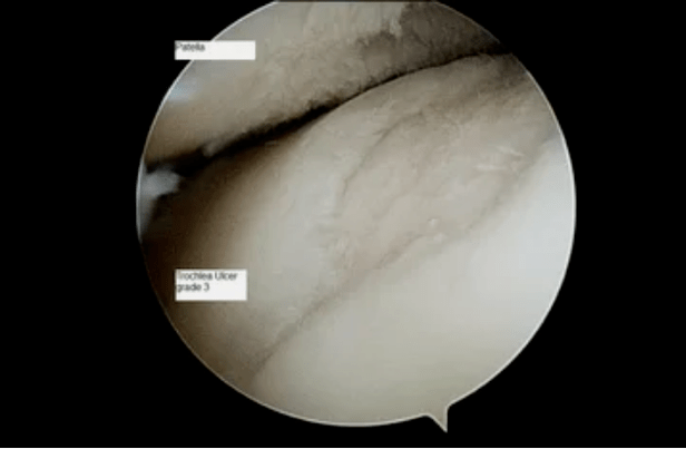 Astroscope view of knee joint with third degree arthrosis