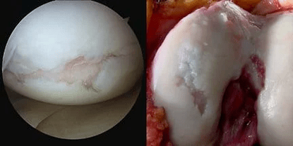 Knee joint surface image