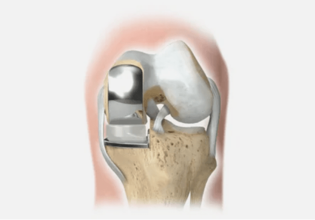 Part of the joint is damaged