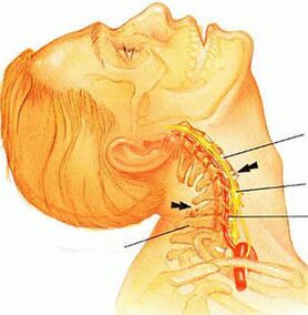 cervical osteochondrosis