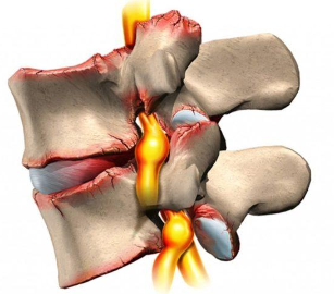 Osteochondrosis of the vertebral column